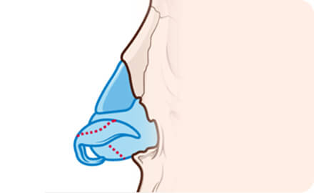 코끝 개선 및 콧등 융비술 1